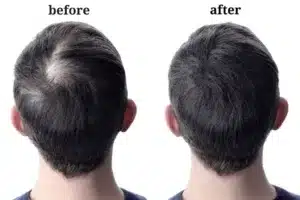 Stop Hair Loss