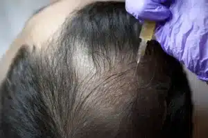 PRP Hair Treatment