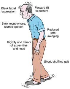 Parkinson's_ Symptoms